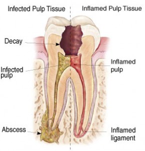 Why Do I Need a Root Canal Raleigh Endodontist