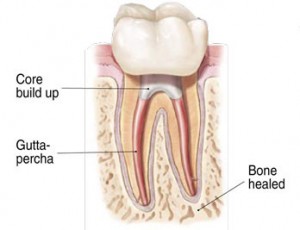 Raleigh Endodontist Root Canal Pic