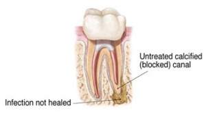 Root Canal Retreatment Raleigh Endodontist