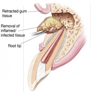 Surgical Root Canal Apicoectomy explanation Raleigh root canal